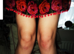 שחיקת סחוס בברכיים? אין דבר כזה!